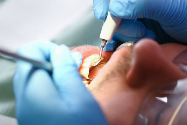 Best Emergency Dentist for Lost Fillings or Crowns in Cascade, ID
